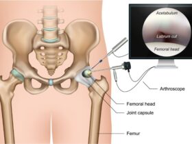 Hip Arthroscopy Specialists: Innovative Solutions for Hip Conditions #beverlyhills #beverlyhillsmagazine #hipproblems #arthroscopyspecialist #surgicalinnovations #physicaltherapy